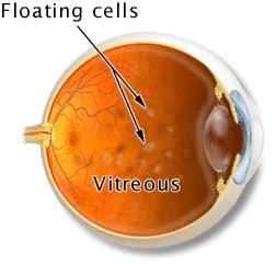 Cataracts image